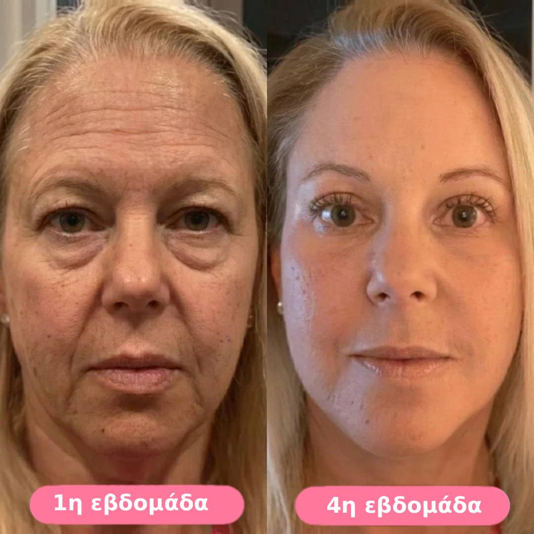 Serum collagen